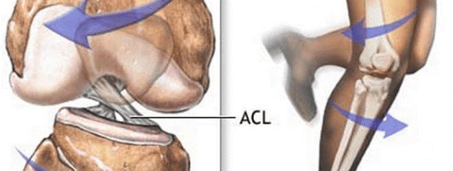 κάκωση του πρόσθιου χιαστού συνδέσμου