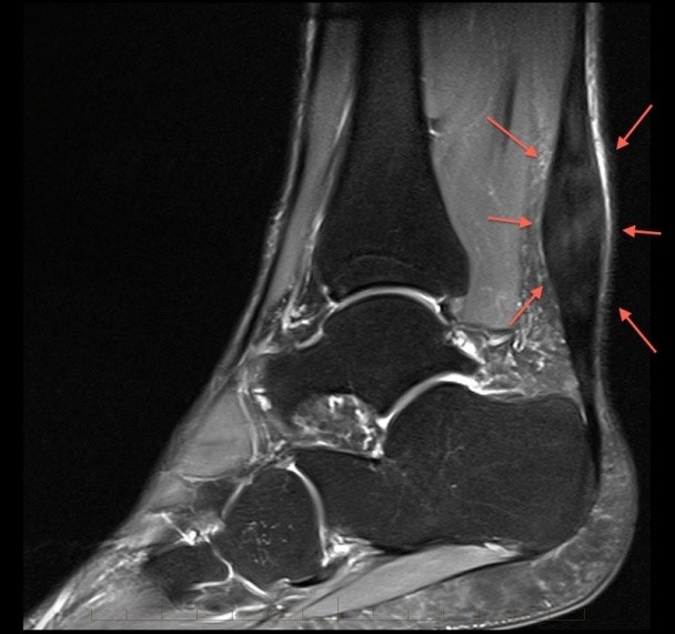 Τενοντοπάθεια Αχιλλείου: Ένας Συχνός Τραυματισμός